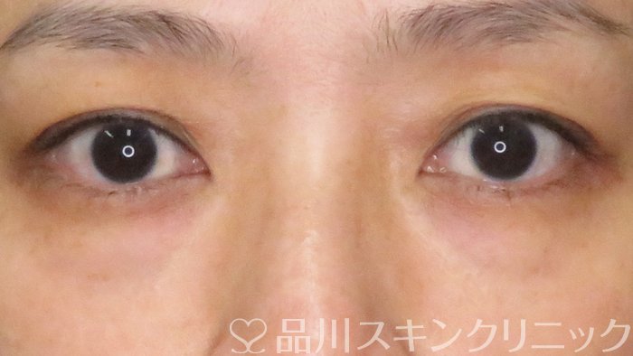 症例NO.63839のBEFORE写真