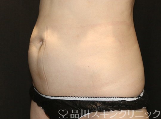 症例NO.70566のAFTER写真