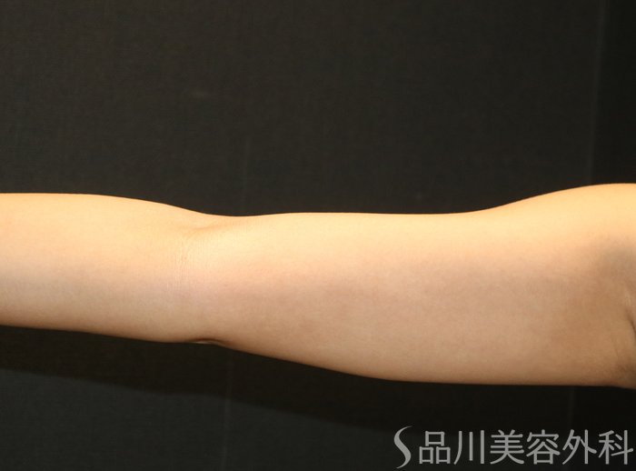 症例NO.72280のAFTER写真