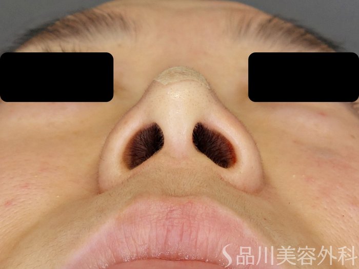 症例NO.71422のAFTER写真