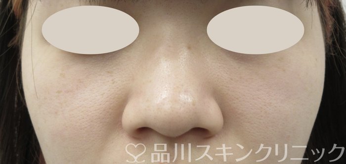 症例NO.65598のBEFORE写真