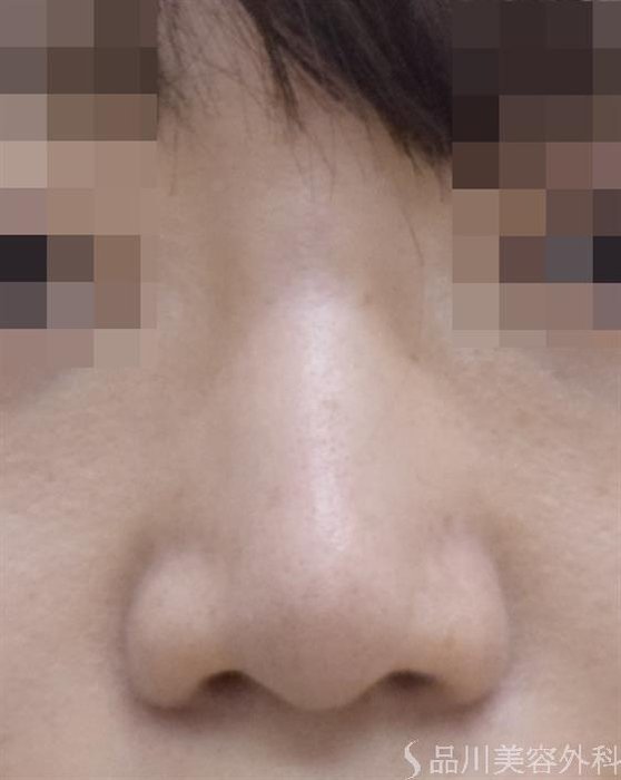症例NO.47698のAFTER写真