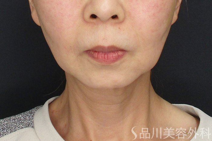 症例NO.72176のAFTER写真