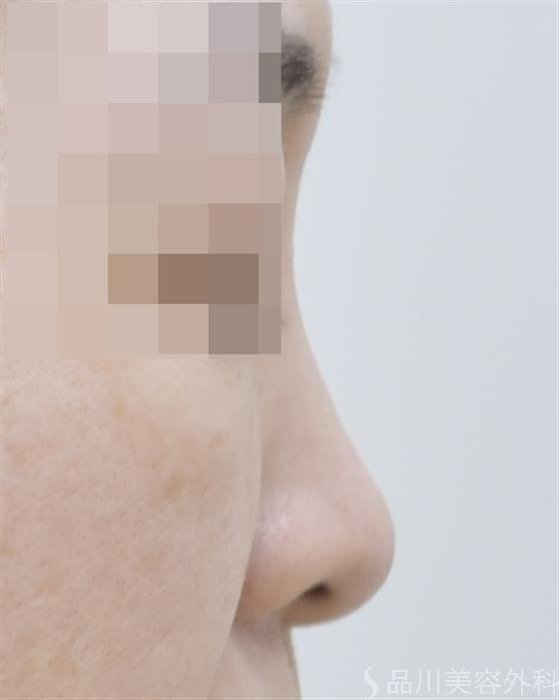 症例NO.46181のBEFORE写真