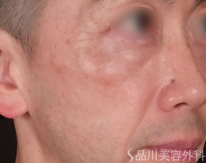 症例NO.70264のAFTER写真