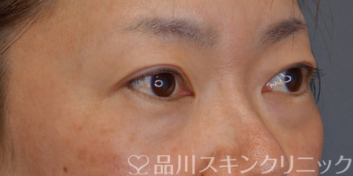 症例NO.73114のBEFORE写真