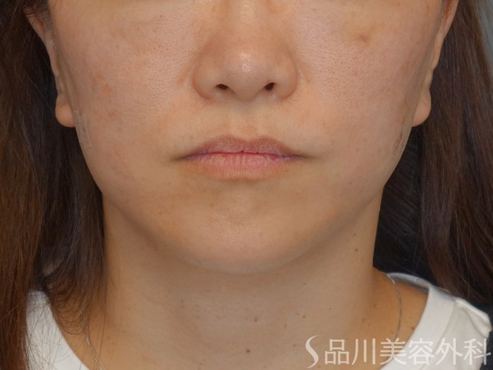 症例NO.72619のAFTER写真