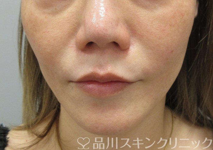 症例NO.69943のBEFORE写真