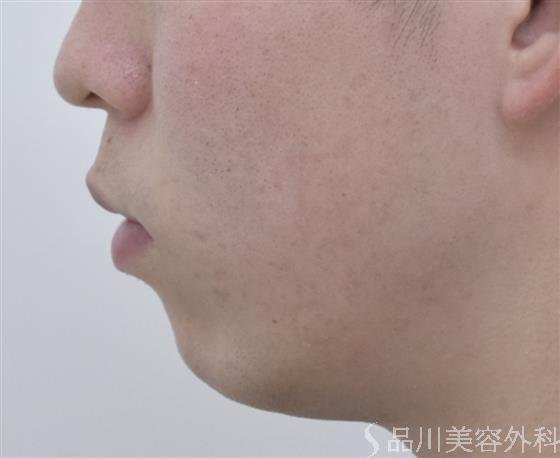 症例NO.47917のBEFORE写真