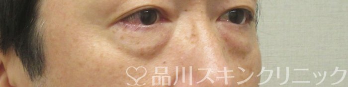 症例NO.74836のBEFORE写真