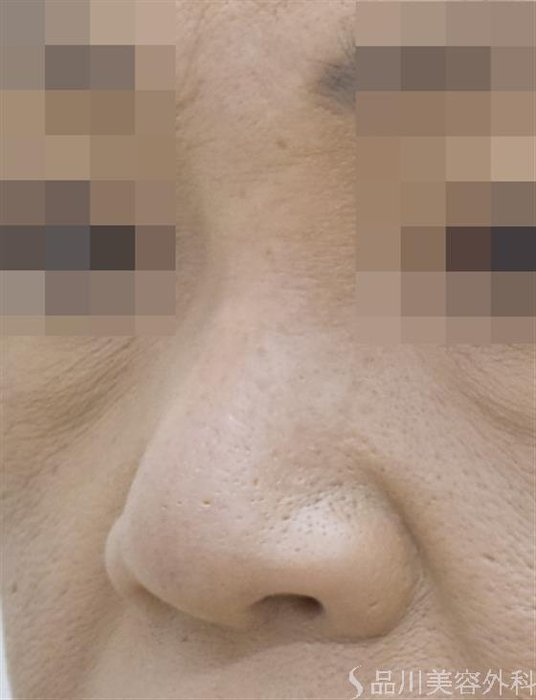 症例NO.51563のBEFORE写真