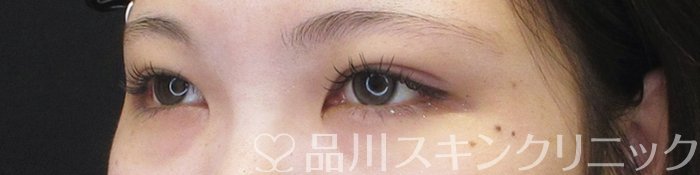 症例NO.67573のAFTER写真