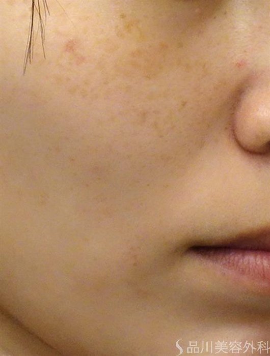 症例NO.37368のBEFORE写真
