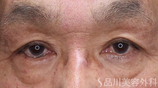 症例NO.69204のBEFORE写真