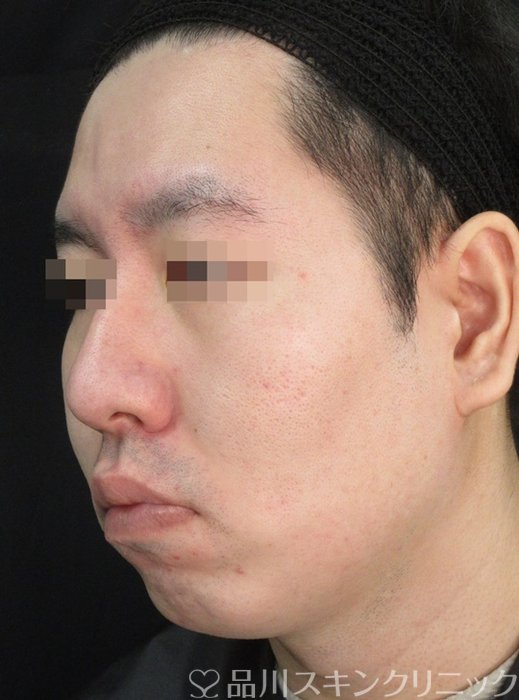 症例NO.72307のAFTER写真