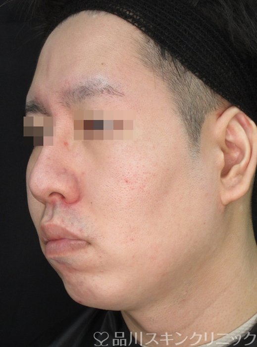 症例NO.72307のBEFORE写真