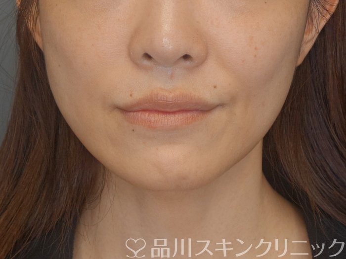 症例NO.72519のBEFORE写真