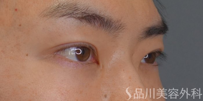 症例NO.74969のAFTER写真