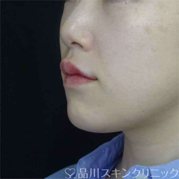症例NO.70902のAFTER写真