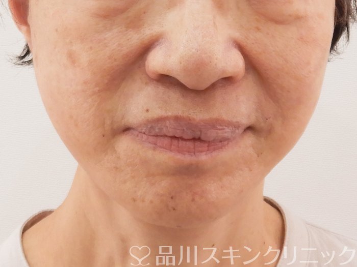症例NO.62649のAFTER写真