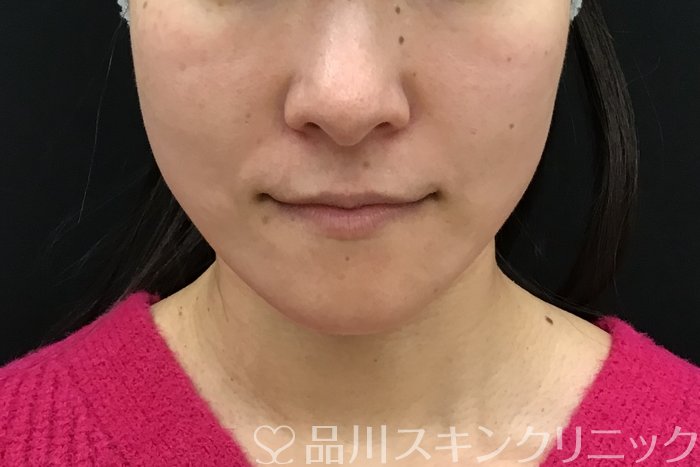 症例NO.71545のAFTER写真