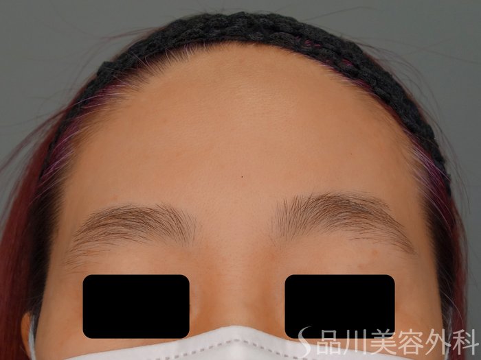 症例NO.70251のBEFORE写真