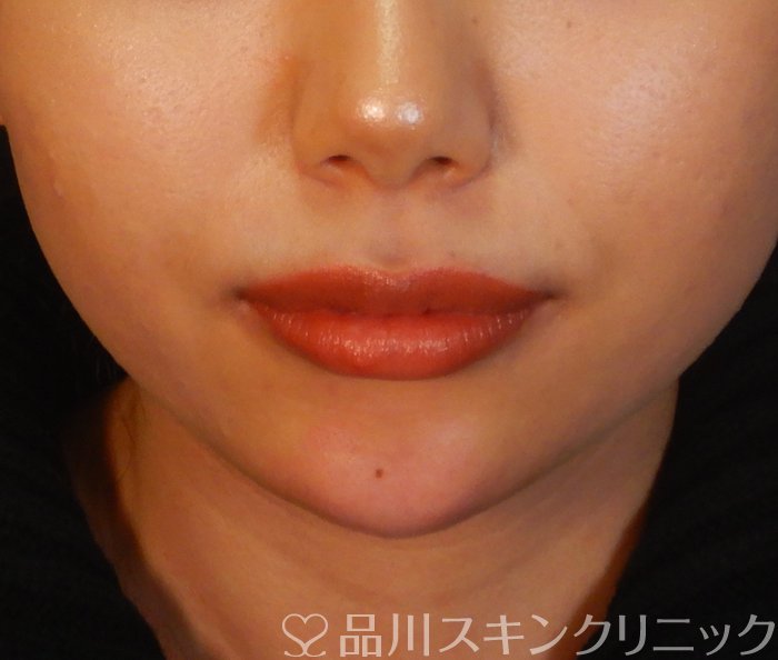 症例NO.66225のAFTER写真