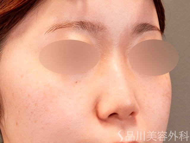 症例NO.69913のAFTER写真