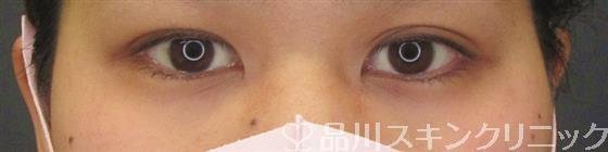 症例NO.60589のBEFORE写真