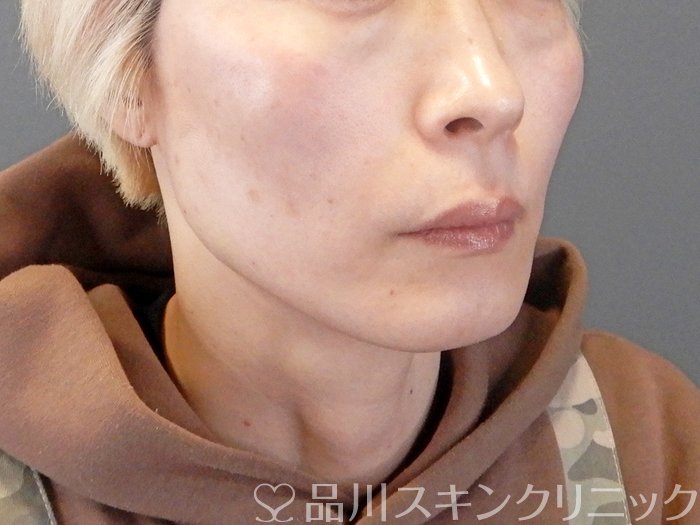 症例NO.63541のAFTER写真