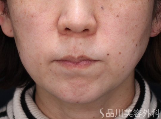 症例NO.73872のBEFORE写真