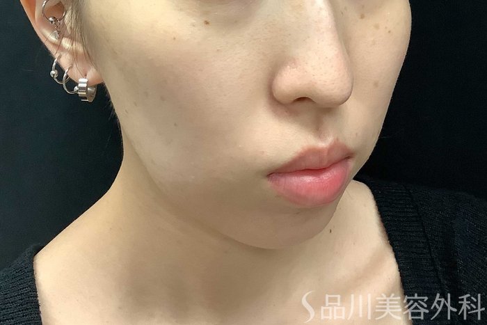 症例NO.69775のBEFORE写真