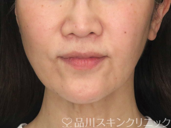症例NO.65063のBEFORE写真