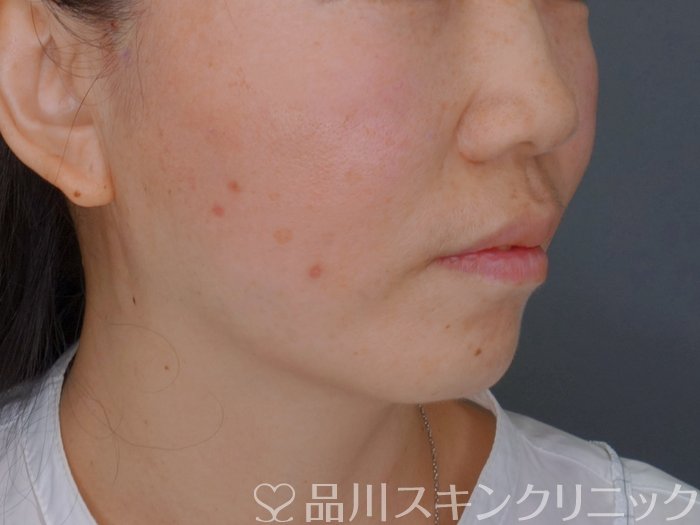 症例NO.74181のAFTER写真