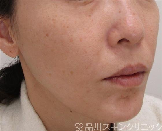 症例NO.43048のAFTER写真