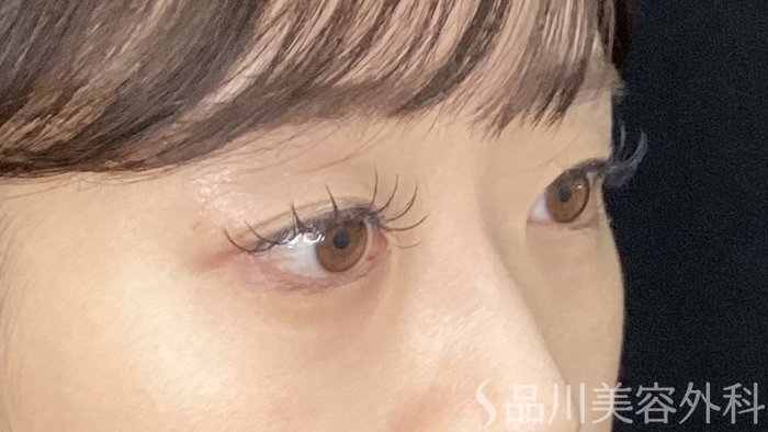 症例NO.72005のBEFORE写真