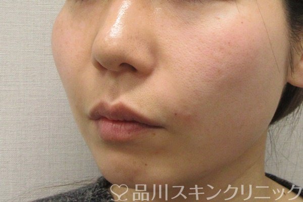 症例NO.69277のAFTER写真