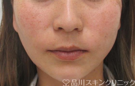 症例NO.26761のAFTER写真