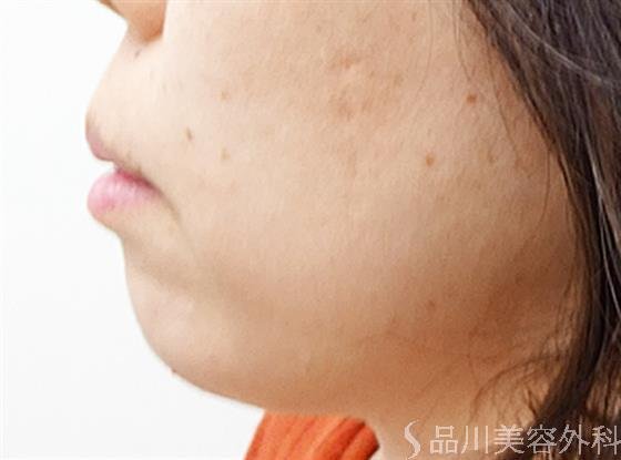 症例NO.32519のAFTER写真