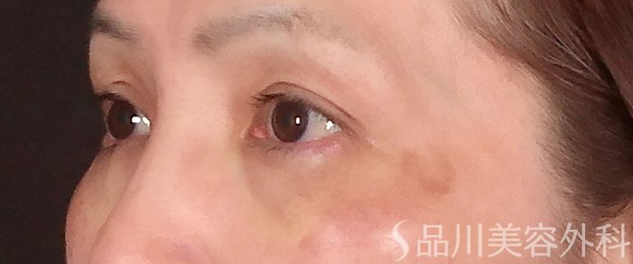 症例NO.70126のAFTER写真