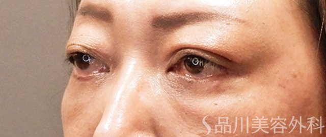症例NO.69997のAFTER写真