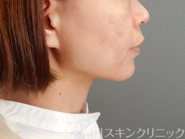 症例NO.63835のAFTER写真