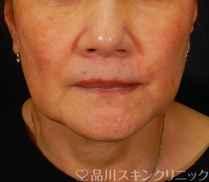 症例NO.67390のBEFORE写真