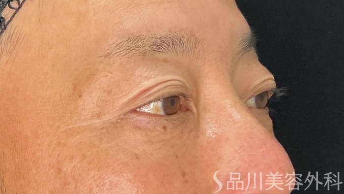 症例NO.71845のAFTER写真