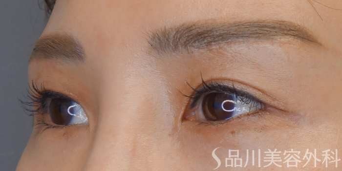 症例NO.72155のAFTER写真