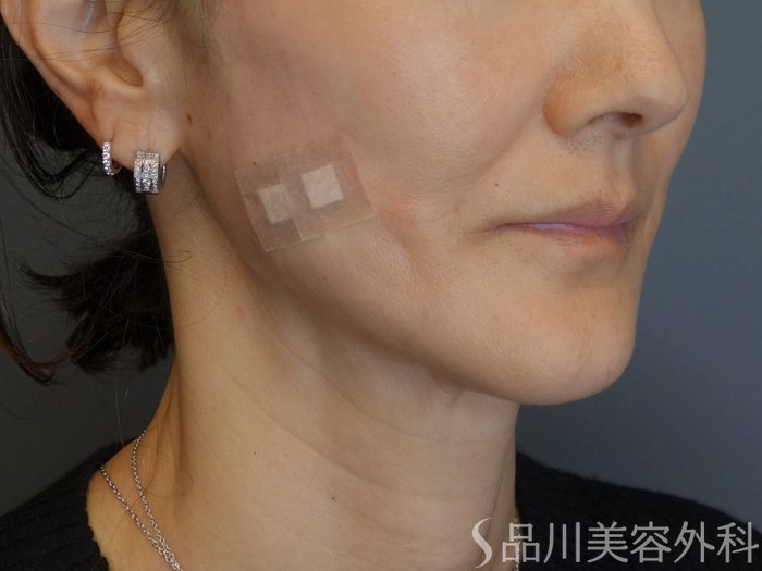 症例NO.72926のAFTER写真