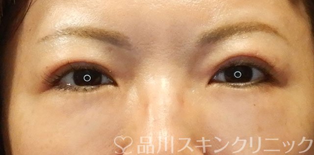 症例NO.65250のAFTER写真