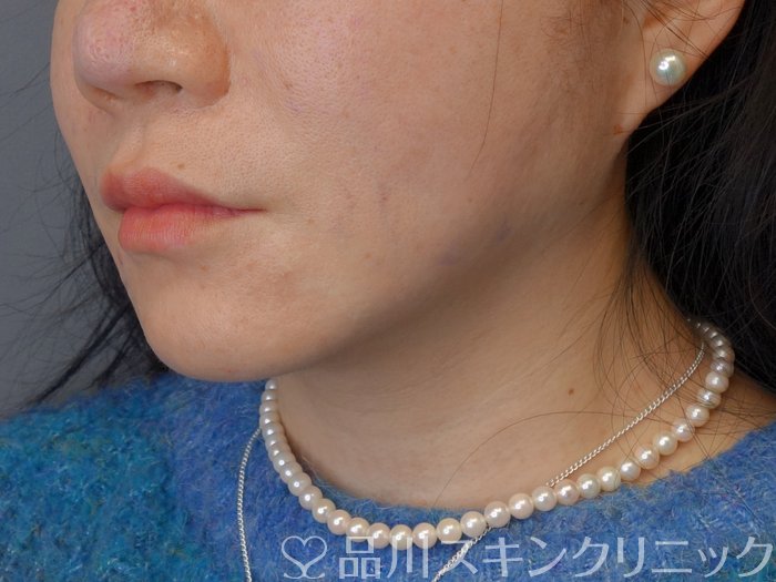 症例NO.72934のAFTER写真