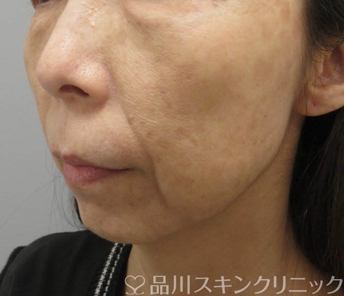 症例NO.74273のBEFORE写真