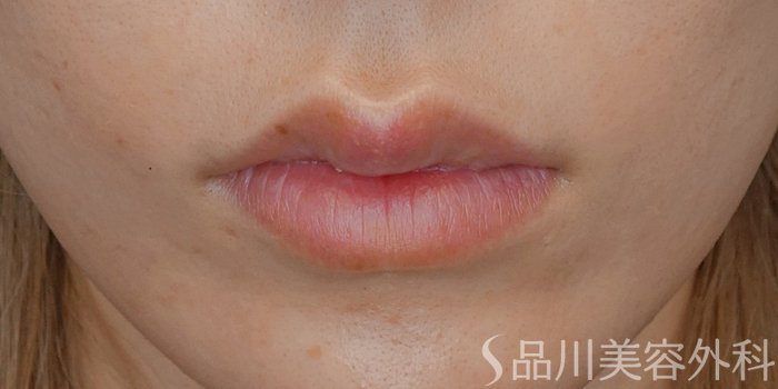 症例NO.72195のBEFORE写真